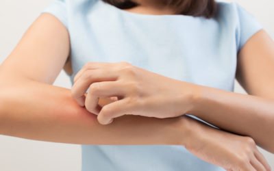 Estas son las alergias más frecuentes en la piel