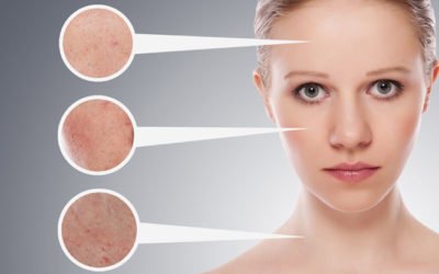 Cáncer de piel: el riesgo de ser asintomático