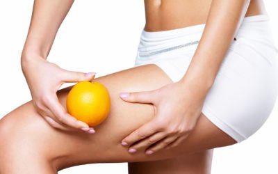 Celulitis: lo que usted tiene que saber