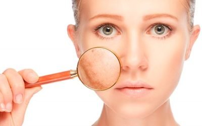 Melasma ¿Qué es?
