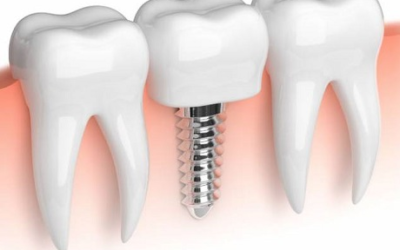 ¿Existe el fracaso en los implantes dentales? ¿Qué pasa?