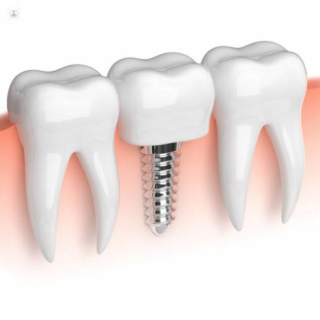 ¿Existe el fracaso en los implantes dentales? ¿Qué pasa?