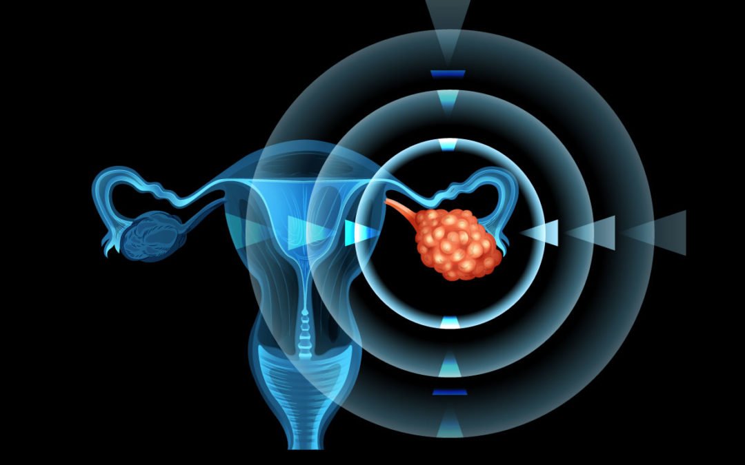 Claves sobre el Síndrome de Ovario Poliquístico