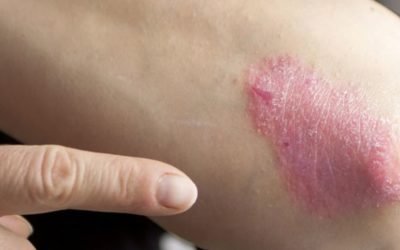 ¿A qué partes del cuerpo afecta la psoriasis?