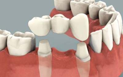 Puentes dentales: ¿cómo se hacen?