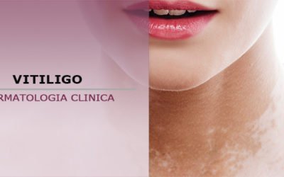 Vitíligo: conoce qué es y cuáles son los tratamientos