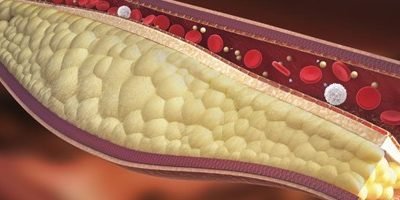 Controlar la hipercolesterolemia, básico para una buena salud