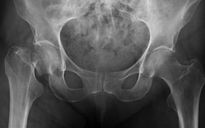 Tamizaje para la prevención de fracturas osteporóticas en Atención Primaria