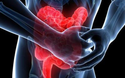 ¿Qué saber sobre la Enfermedad Inflamatoria Intestinal?