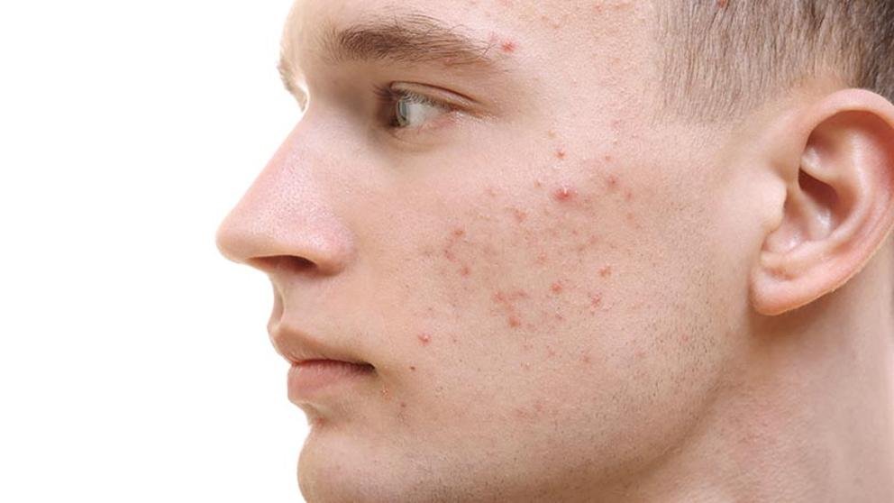 ¿Qué es el acné?