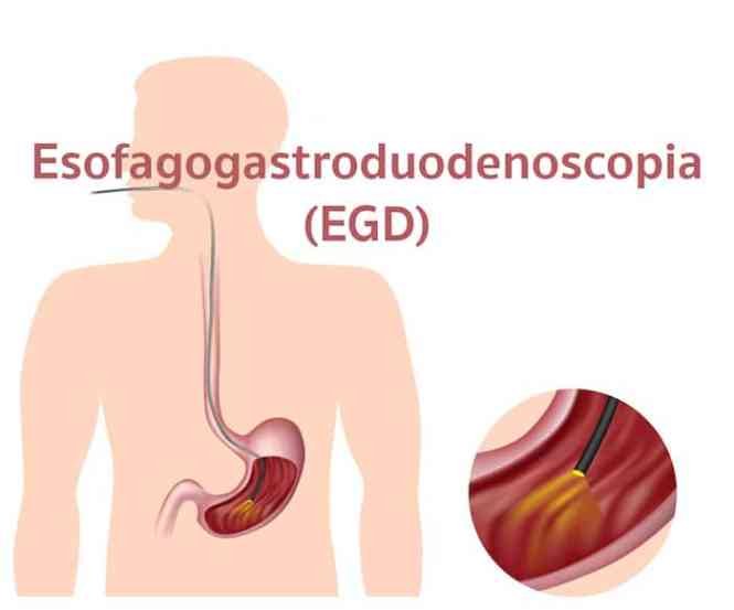 Esofagogastroduodenoscopia – EGD: