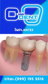 implantes-dentales-clinicdental