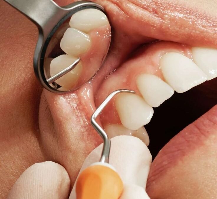 ¿Qué es la regeneración periodontal y cómo ayuda a salvar tus dientes?