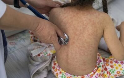 ¿Es posible prevenir las erupciones cutáneas por alergias en los niños?