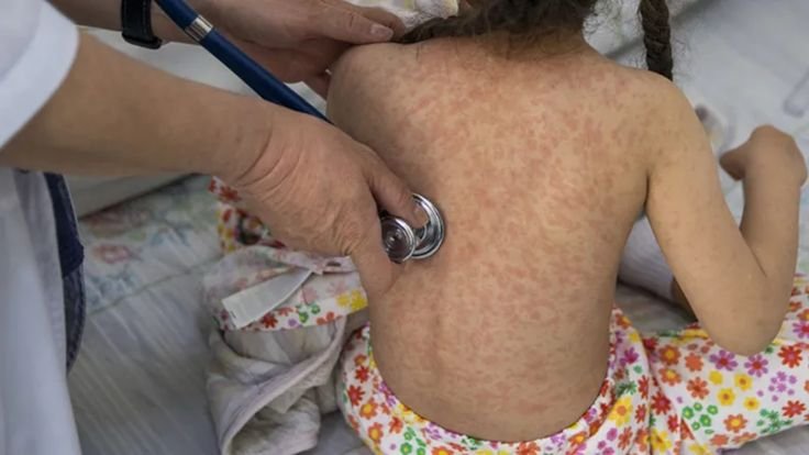 ¿Es posible prevenir las erupciones cutáneas por alergias en los niños?