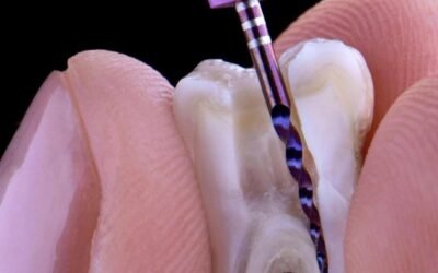 ¿Qué es una endodoncia de vanguardia y cómo ayuda a salvar tu sonrisa natural?